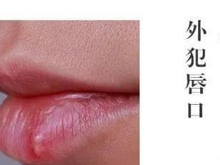 嘴唇肿痒，可能的原因与治疗方法（了解嘴唇肿痒的原因，做好相应的治疗）