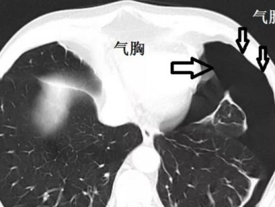 狗狗气胸的原因和预防方法（了解狗狗气胸的危害，保护它们的健康）