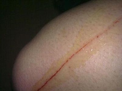 狗狗抓伤伤口的症状与处理方法（了解狗狗抓伤伤口的特征及正确处理方法，保护宠物健康）
