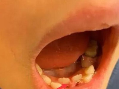 为什么16岁换牙齿少？（探究16岁换牙齿少的原因及其影响）