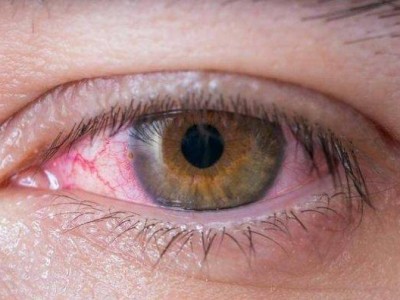 眼睛发红的原因及应对方法（了解眼睛发红的诱因，掌握正确处理方法，保护眼睛健康）